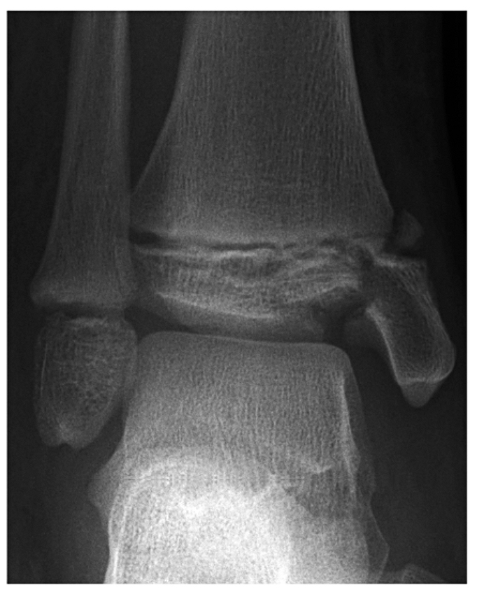 When the ankle’s keystone bone is knocked clean out — can the foot be saved?