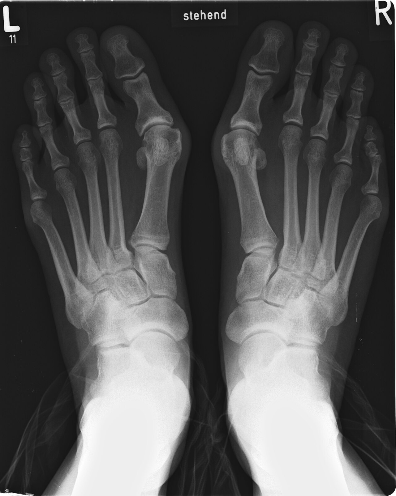 Can a broken foot be looked after without a hospital visit?