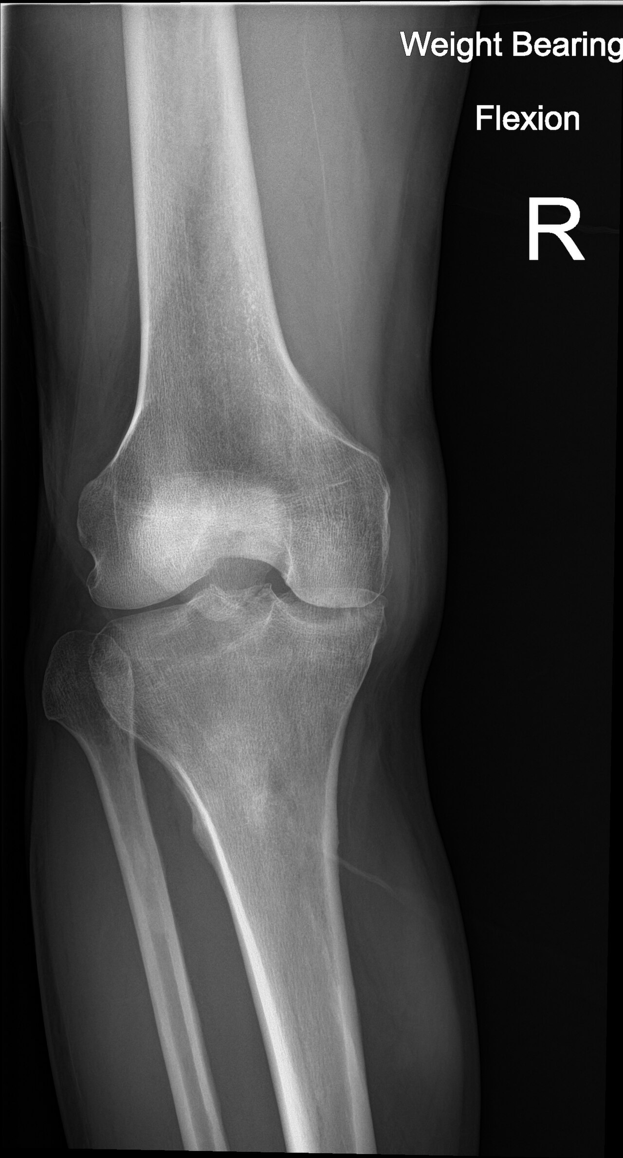 Why a knee-arthritis injection can help women and men differently