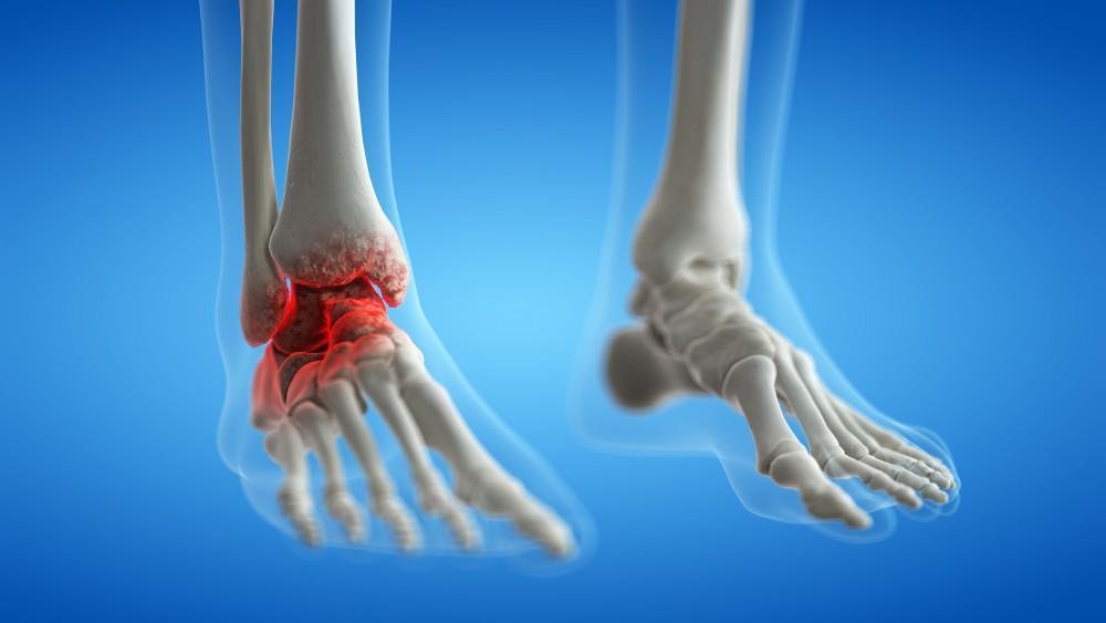 When an ankle replacement hurts — how we tell if it’s infected