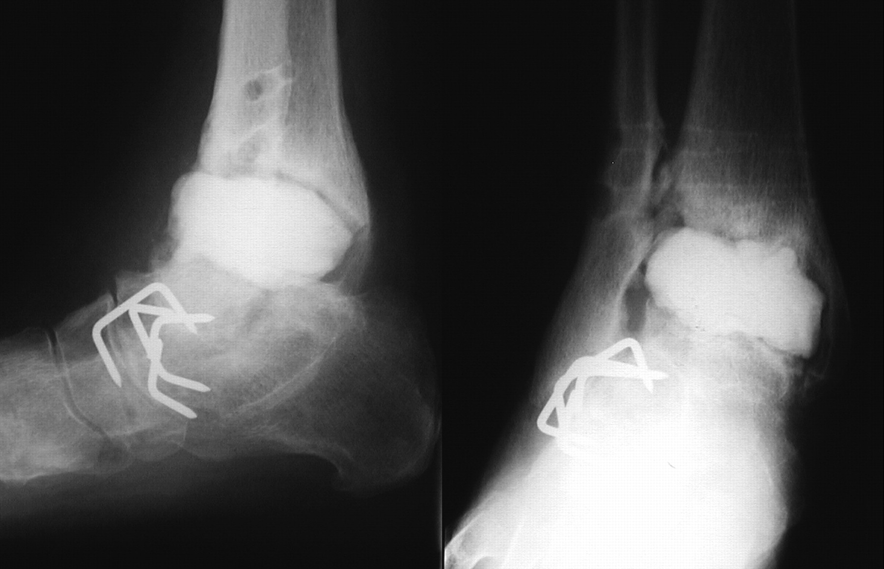 What bacteria really cause infected fractures — six years of UK data