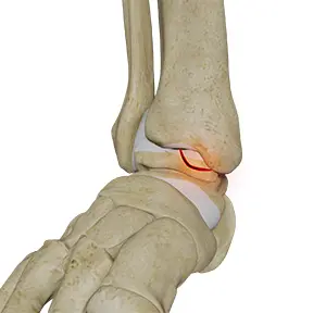 Osteochondral Injuries