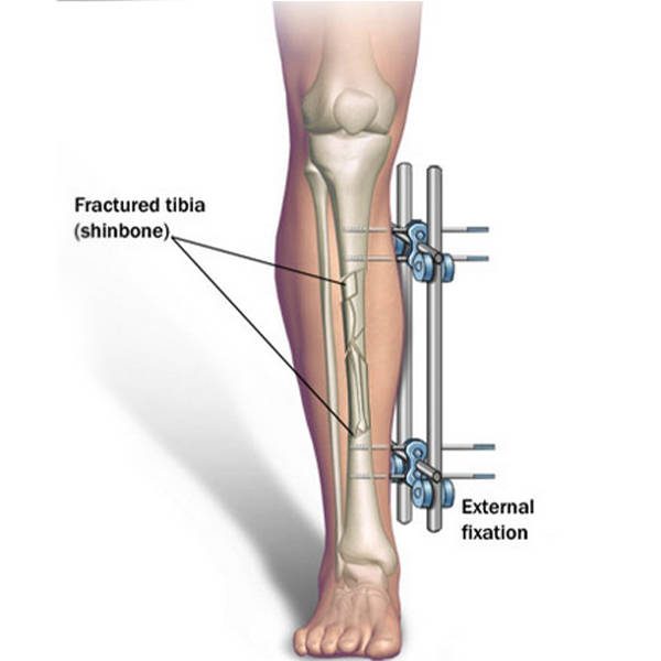 Correcting thigh-bone deformity with millimetre precision — without months in a frame