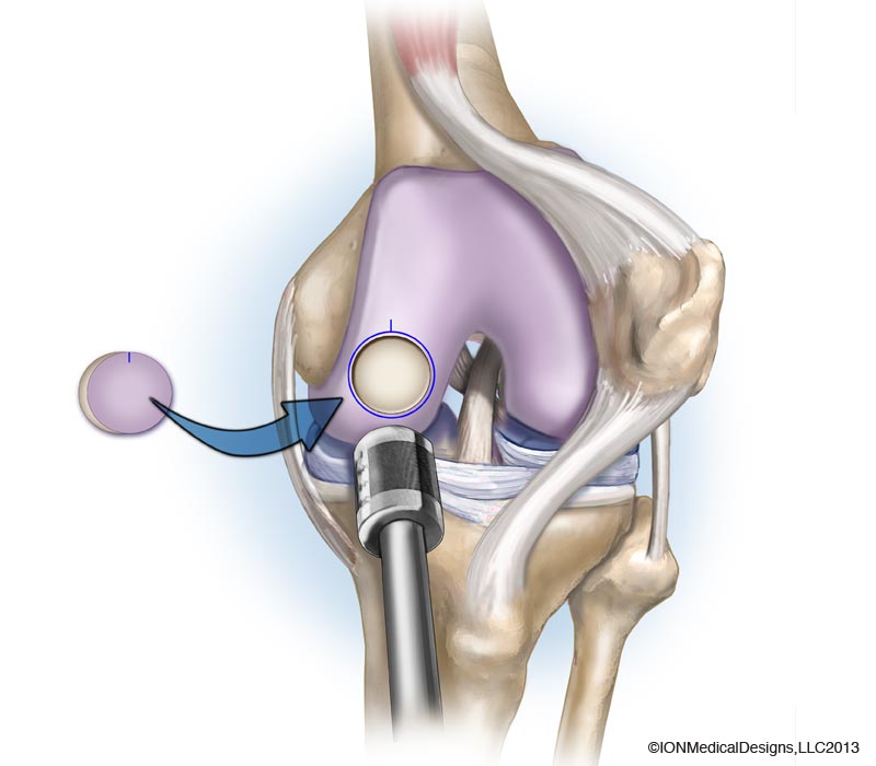 Foot & Ankle Arthritis / Osteoarthritis