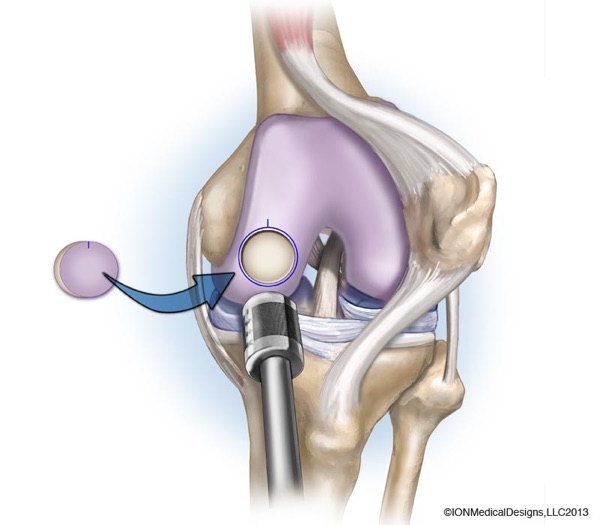 Pilon fractures — when fixing the bone too early is the wrong call