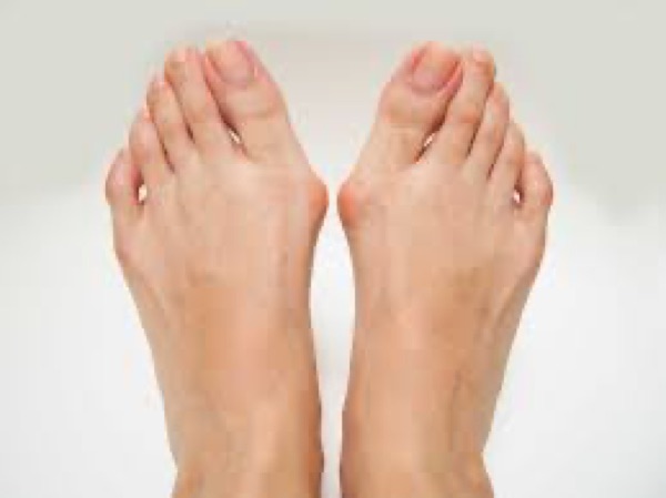 What happens after a talus fracture? Real-world numbers from 100 patients