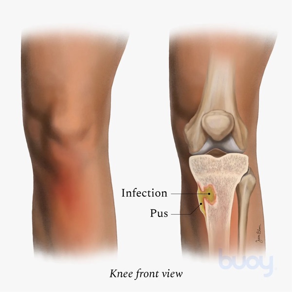 Lisfranc injury — when the bridge plate can stay where it is